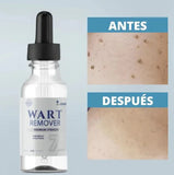 Wart Remover - Removedor de verrugas y lunares
